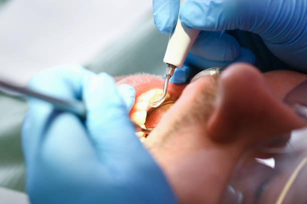 Best Emergency Wisdom Teeth Removal in Teague, TX
